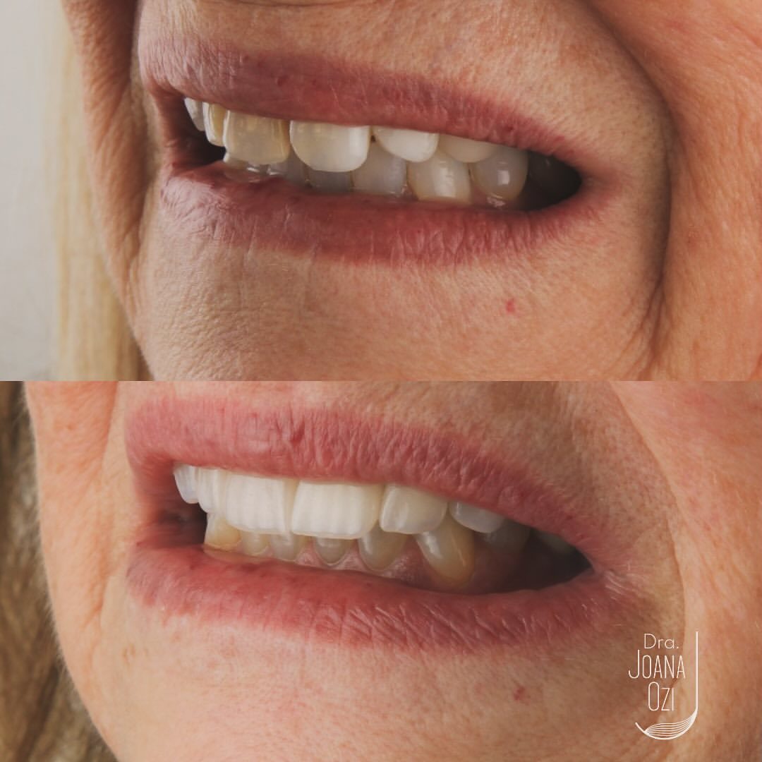 Antes e depois da reabilitação oral com implantes, coroas e lentes, caso real da Clínica Joana Ozi