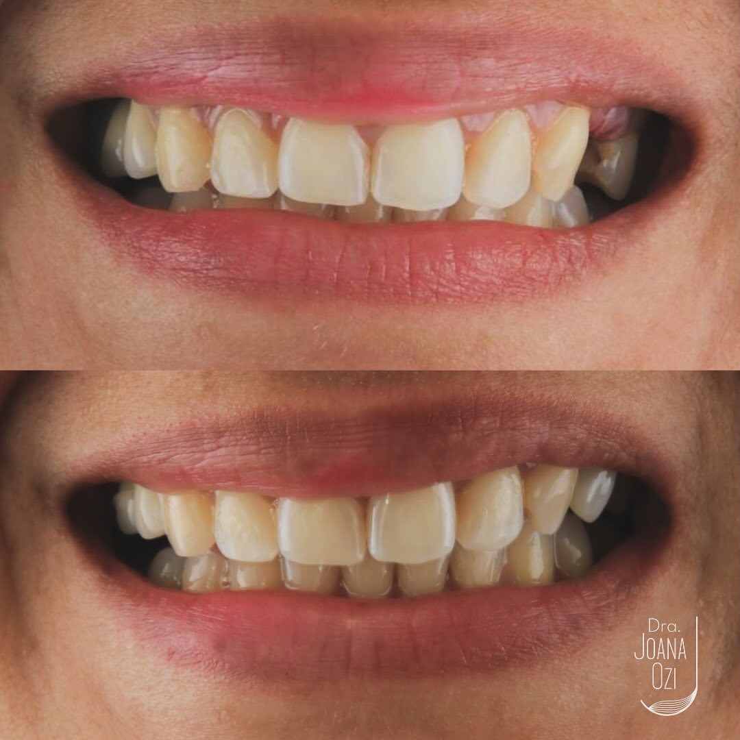Antes e depois da prótese sobre implante, vistos de frente, caso real da Clínica Joana Ozi