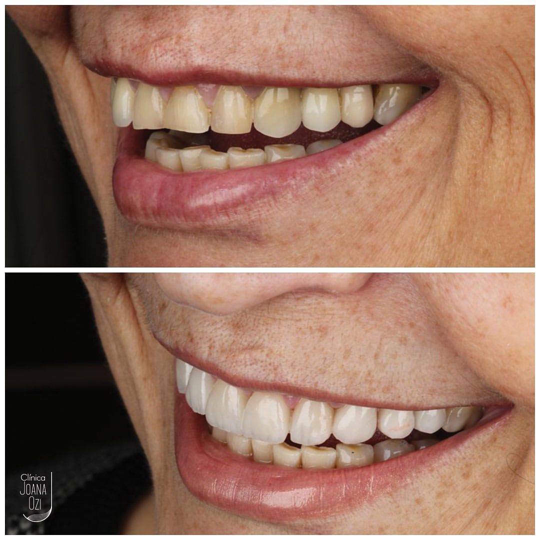 Antes e depois de reabilitação superior com facetas, lentes de contato e coroas, caso real da Clínica Joana Ozi