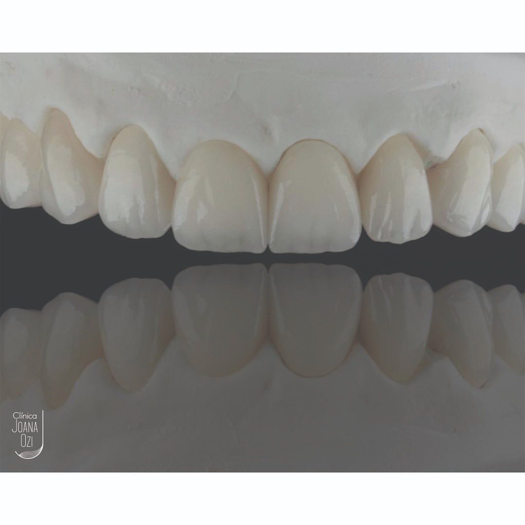 Lentes de contato dental em 8 elementos sobre o modelo de trabalho do laboratório, caso real da Clínica Joana Ozi