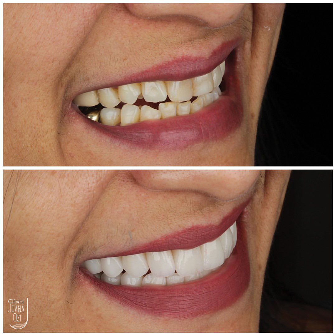 Antes e depois de lentes de contato dental, caso real da Clínica Joana Ozi