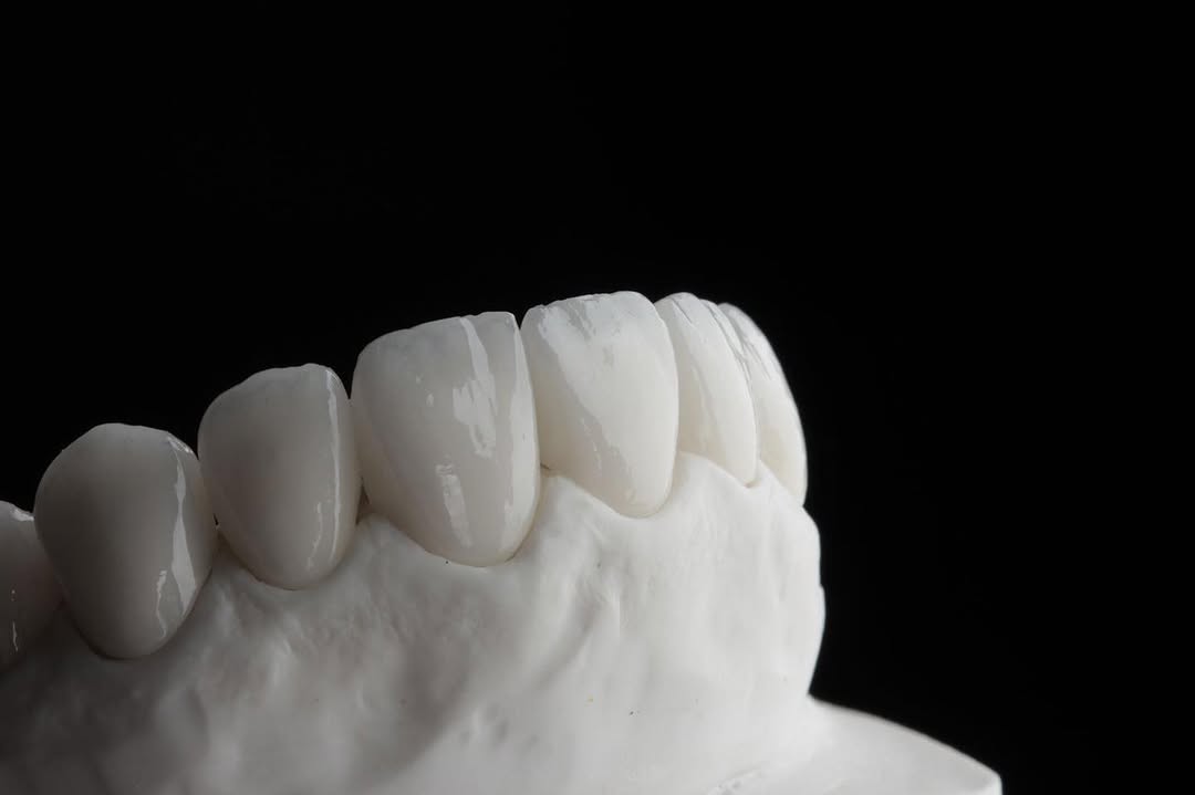 Trabalho de lentes de contato dental finalizado em parceria com o laboratório, Clínica Joana Ozi