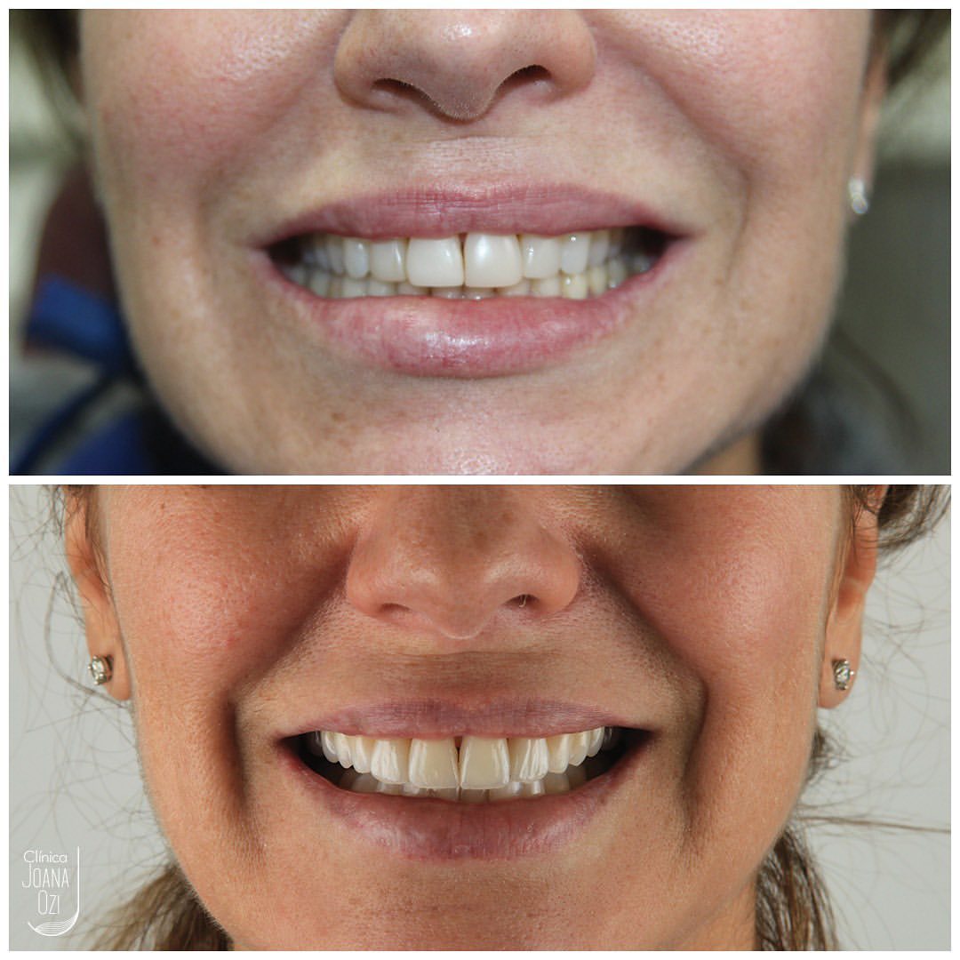 Antes e depois da substituição de lentes de resina antigas, caso real da Clínica Joana Ozi
