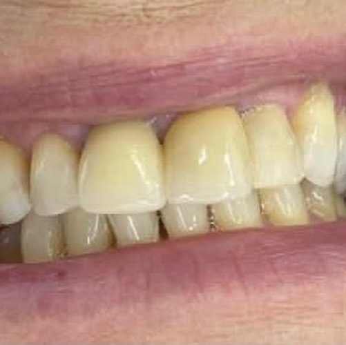 Sorriso antes da reabilitação conduzida em equipe, caso real da Clínica Joana Ozi