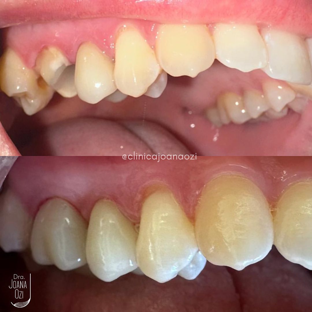 Antes e depois de reabilitação com resultado estético e funcional, caso real da Clínica Joana Ozi